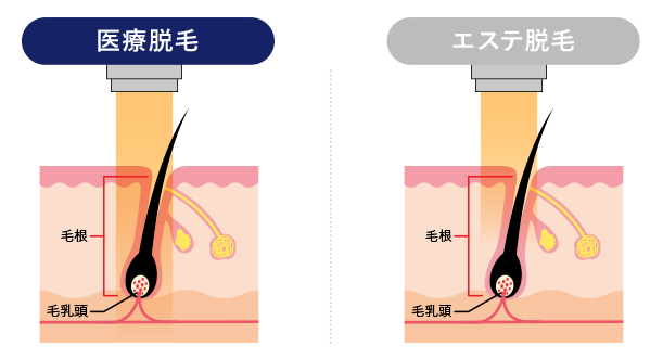 高い脱毛効果
